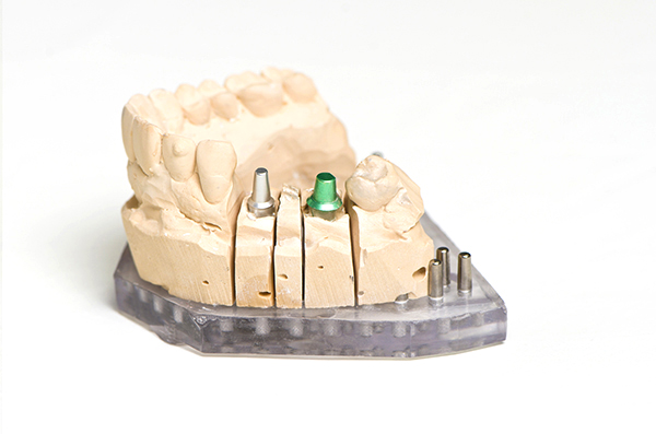 Dental implants drgreenapple.co.za